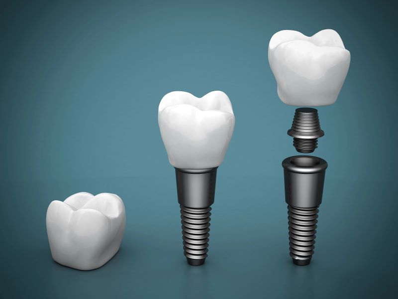Crown Point Family Dentistry specializes in dental implants in Charlotte NC