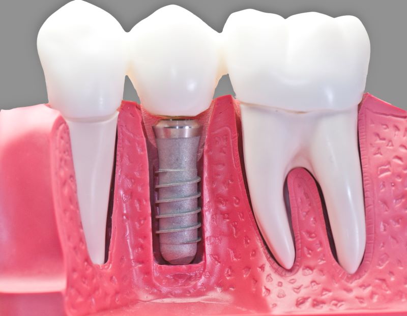 Crown Point Family Dentistry dental implants