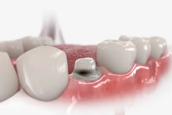 charlotte-dental-crowns-2 - Crown Point Family Dentists Expert dentals crowns at Crown Point Family Dentistry in Charlotte