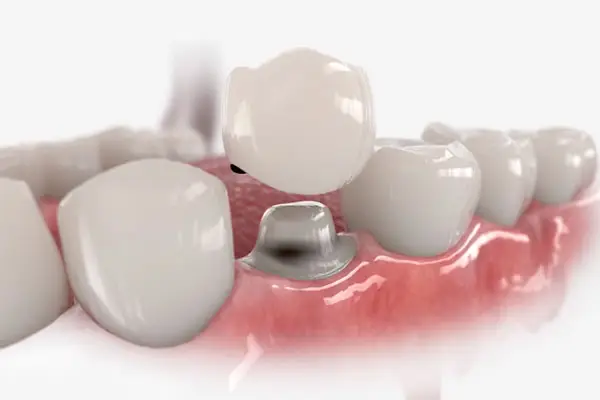 charlotte-dental-crowns-3 - Crown Point Family Dentists The process of making a dental crown, also called caps, by Crown Point Family Dentistry in Charlotte.