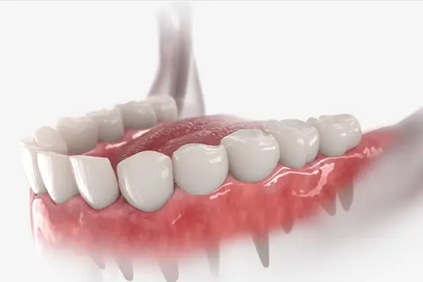 charlotte-dental-crowns-4 - Crown Point Family Dentists Dental crowns in Charlotte by Crown Point Family Dentistry can help restore decayed or fractured teeth.