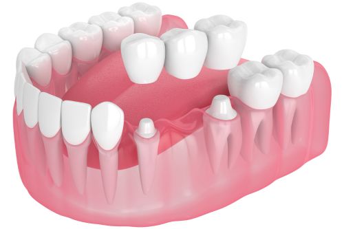 dental bridge 3d illustration | Charlotte Dentist