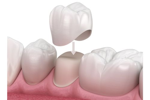 dental crown 3d illustration | Charlotte Dentist