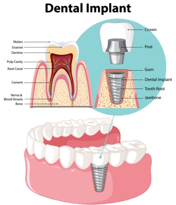 dental implant illustration explains the process | Charlotte Dentist