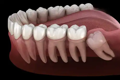Gentle wisdom teeth removal in Charlotte, NC by Crown Point Family Dentistry